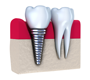 illustration of implant screwed into bone next to real tooth, Dental Implants Bolingbrook IL